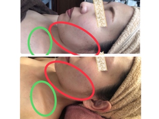 光フェイシャル