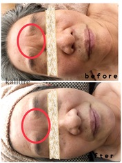 ラジオ波フェイシャル