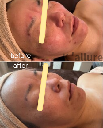 最強エイジングケアフェイシャル