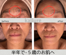 最強エイジングケアフェイシャル